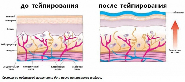 Тейпирование живота и боков для похудения. Схема, как делается, фото, результаты